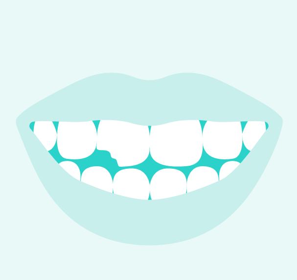 S.O.S. – Zahn abgebrochen