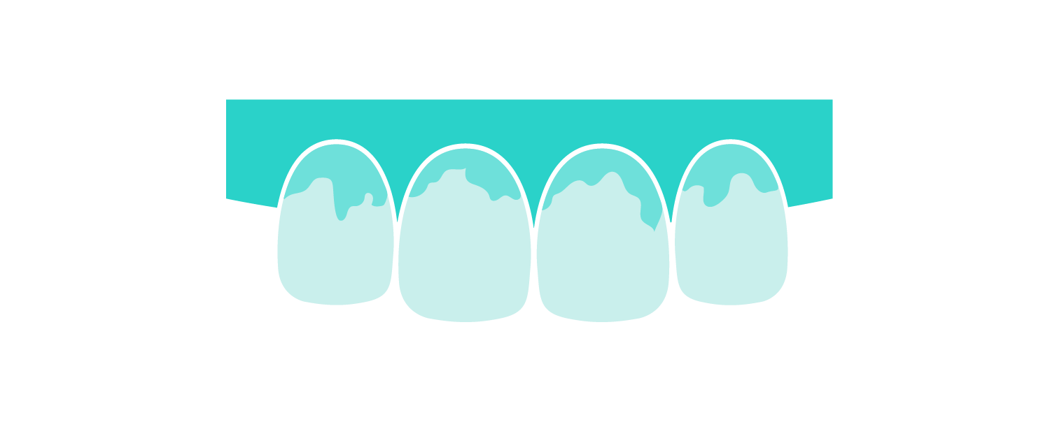 Anfärbetabletten im Test: So erkennst du Plaque richtig